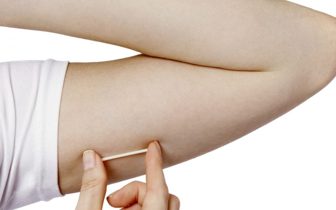 Birth Control 101: The Implant